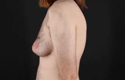 Female To Male Breast Before & After Patient #4075