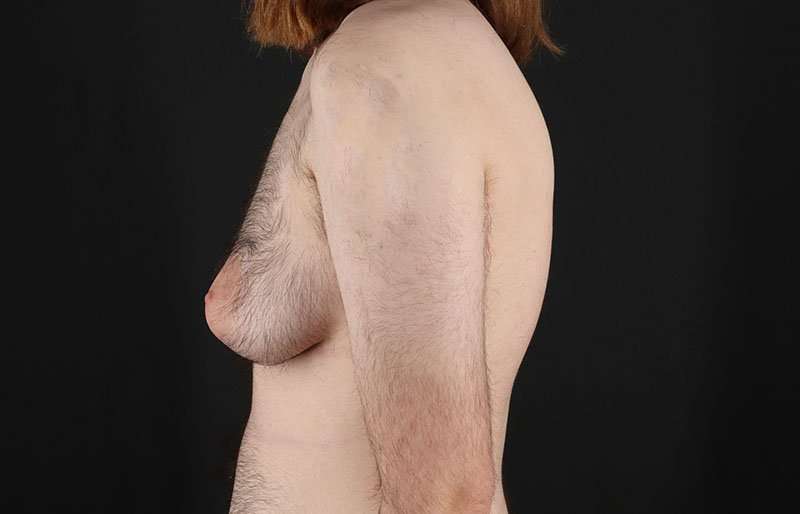 Female To Male Breast Before & After Patient #4075