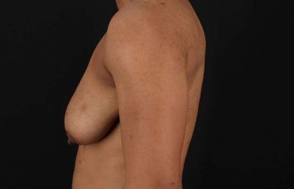 Female To Male Breast Before & After Patient #4086
