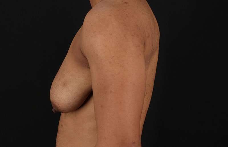 Female To Male Breast Before & After Patient #4086