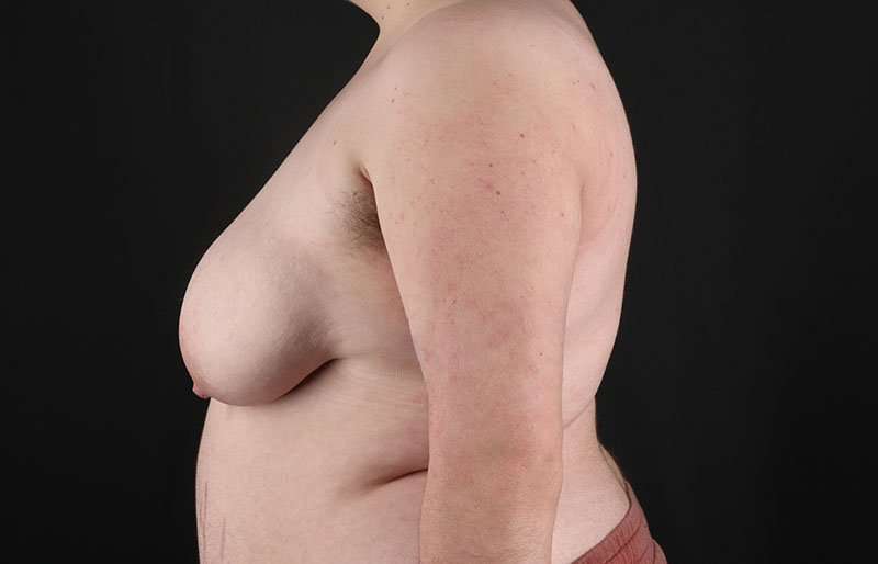 Female To Male Breast Before & After Patient #4097
