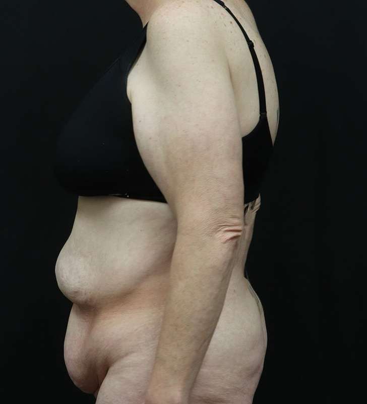 Abdominoplasty (Tummy Tuck) Before & After Patient #948