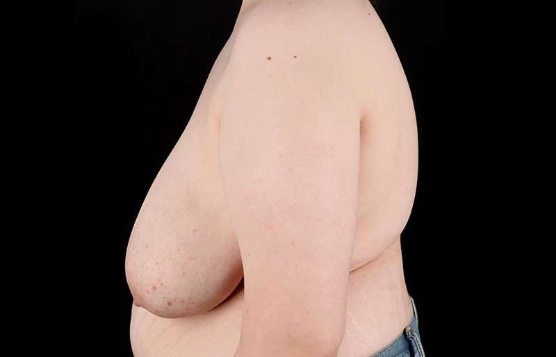 Female To Male Breast Before & After Patient #4130