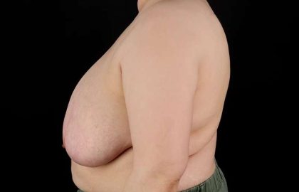 Female To Male Breast Before & After Patient #4141