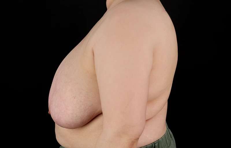 Female To Male Breast Before & After Patient #4141
