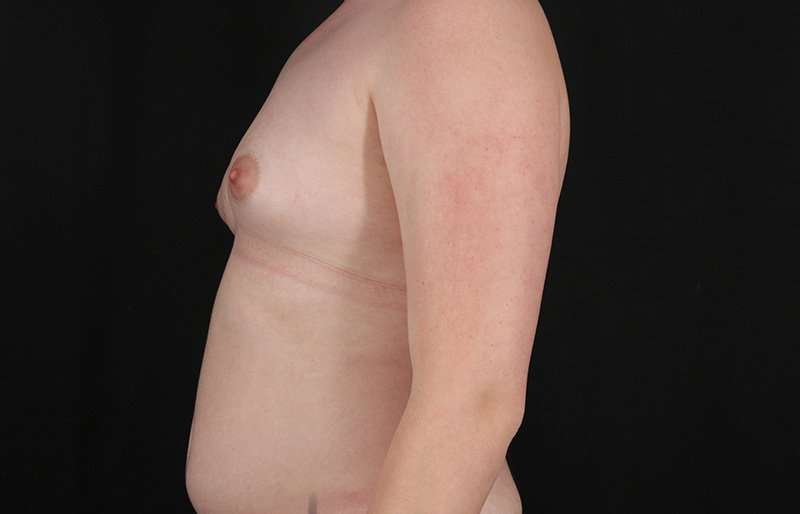 Female To Male Breast Before & After Patient #4163