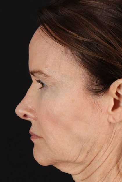 Fat Grafting To The Face Before & After Patient #4199