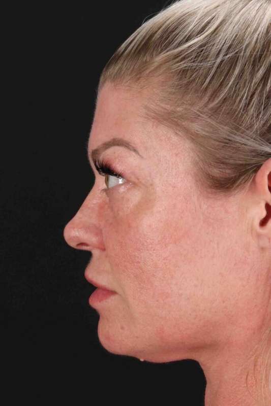 Fat Grafting To The Face Before & After Patient #4232