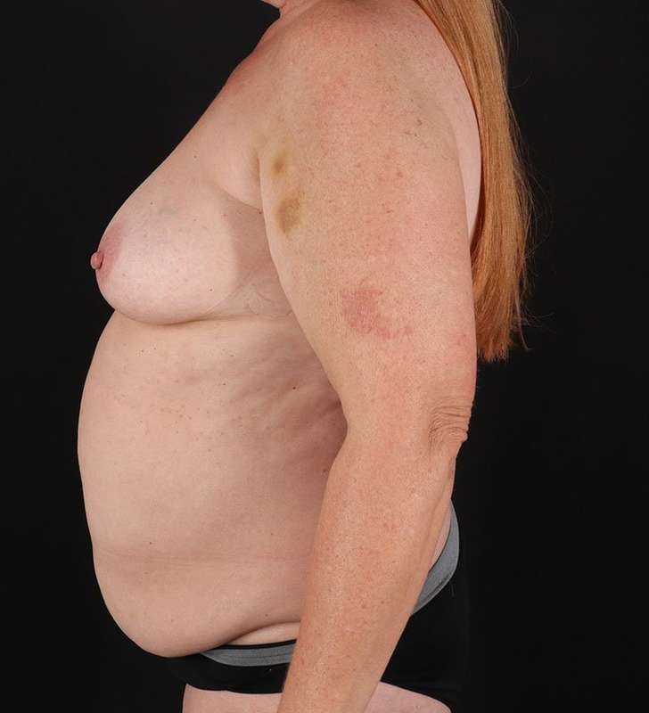 Abdominoplasty (Tummy Tuck) Before & After Patient #962