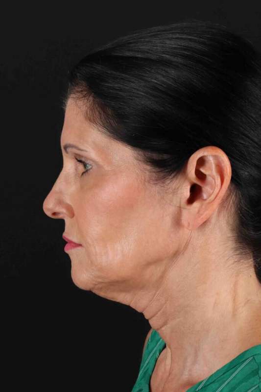 Fat Grafting To The Face Before & After Patient #4254
