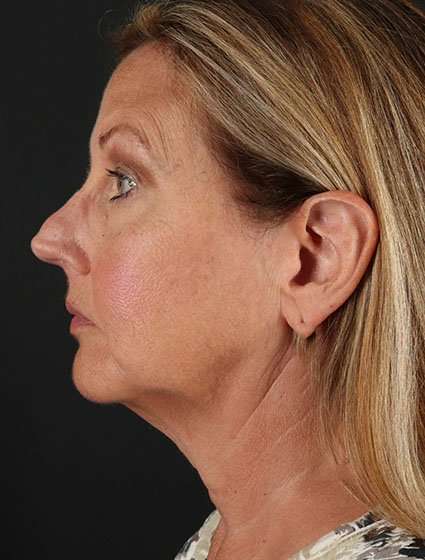 Fat Grafting To The Face Before & After Patient #4265