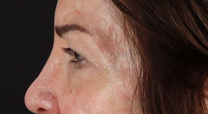 Blepharoplasty (Eyelid Surgery) Before & After Patient #4316
