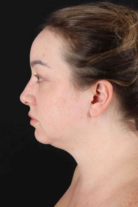 Blepharoplasty (Eyelid Surgery) Before & After Patient #4327