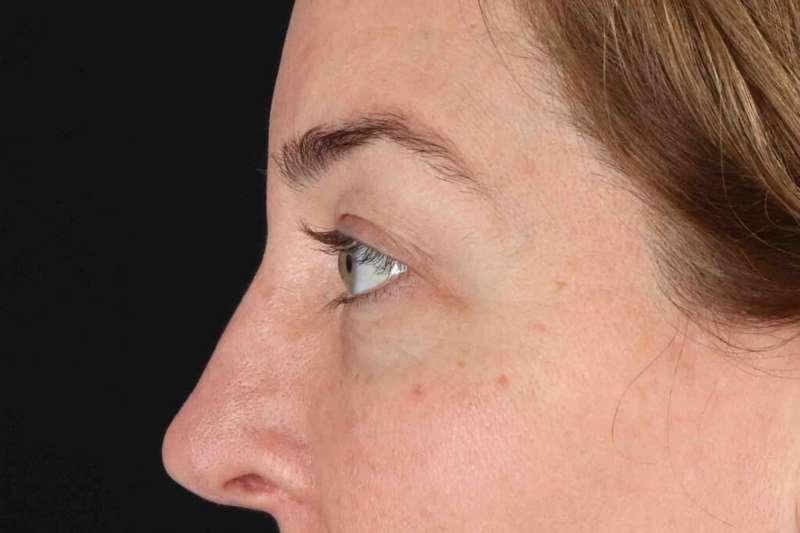 Blepharoplasty (Eyelid Surgery) Before & After Patient #4338