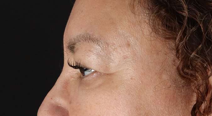 Blepharoplasty (Eyelid Surgery) Before & After Patient #4349