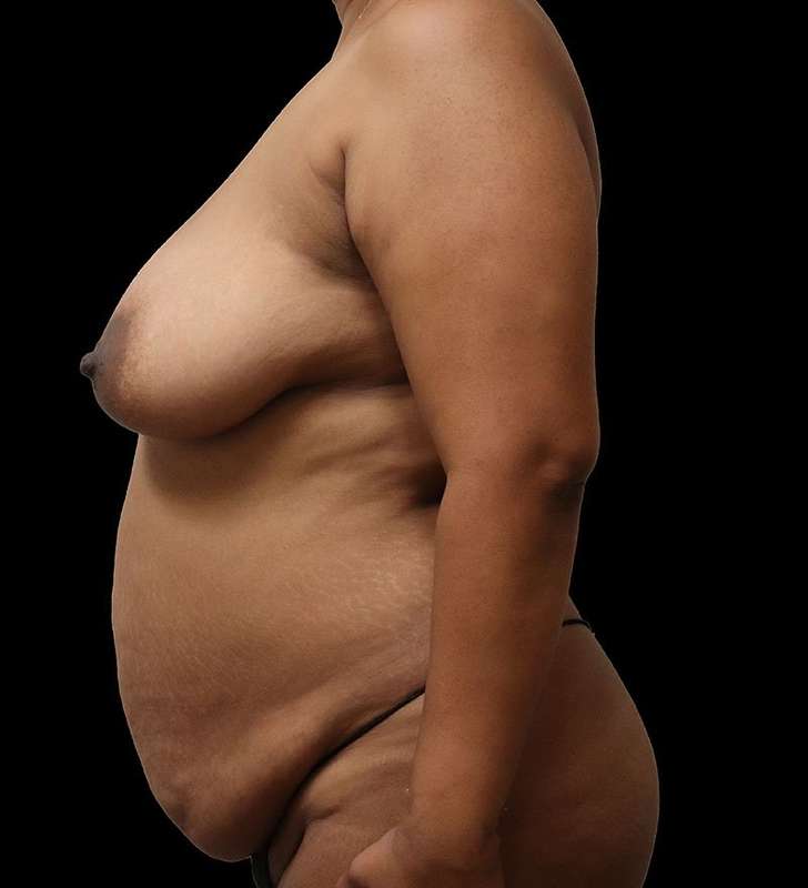 Abdominoplasty (Tummy Tuck) Before & After Patient #975