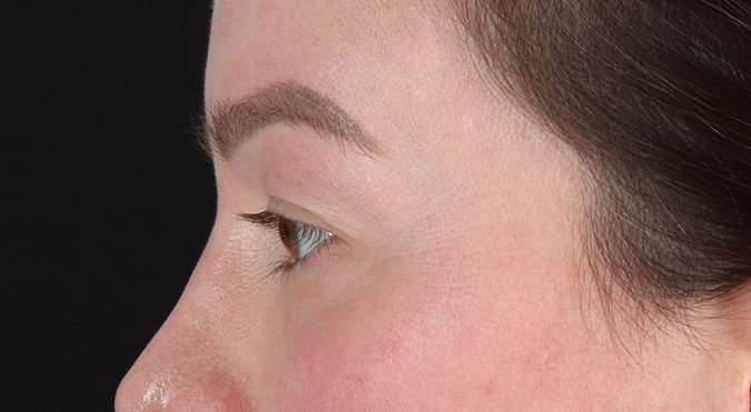 Blepharoplasty (Eyelid Surgery) Before & After Patient #4360