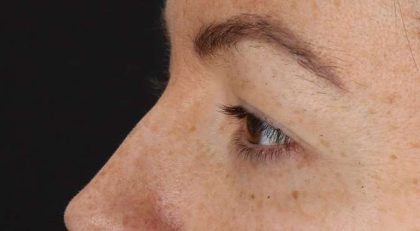 Blepharoplasty (Eyelid Surgery) Before & After Patient #4371