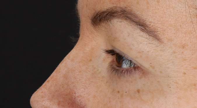 Blepharoplasty (Eyelid Surgery) Before & After Patient #4371