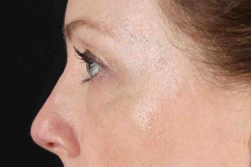 Blepharoplasty (Eyelid Surgery) Before & After Patient #4382