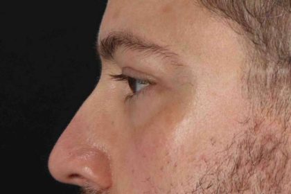 Blepharoplasty (Eyelid Surgery) Before & After Patient #4393