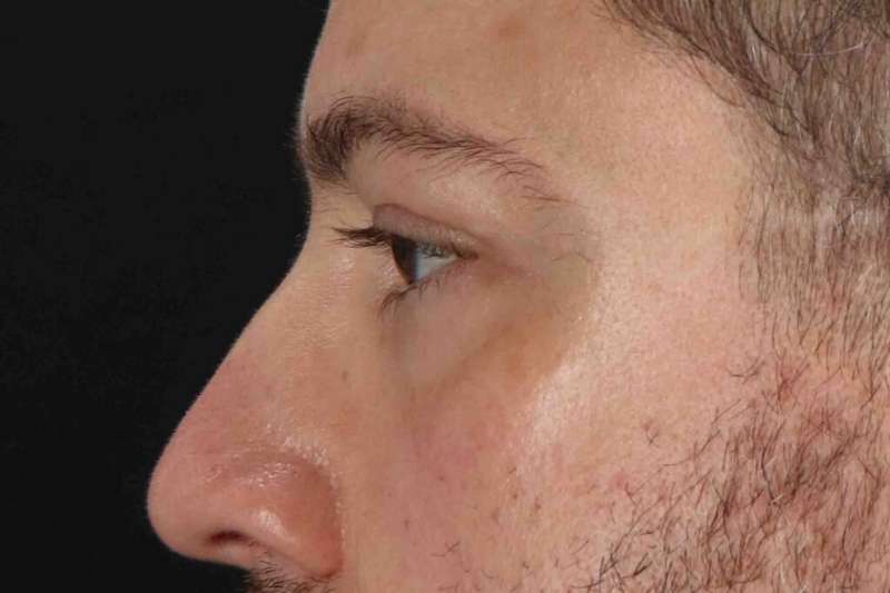 Blepharoplasty (Eyelid Surgery) Before & After Patient #4393