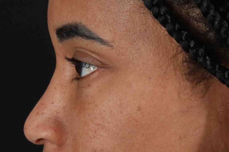 Blepharoplasty (Eyelid Surgery) Before & After Patient #4404