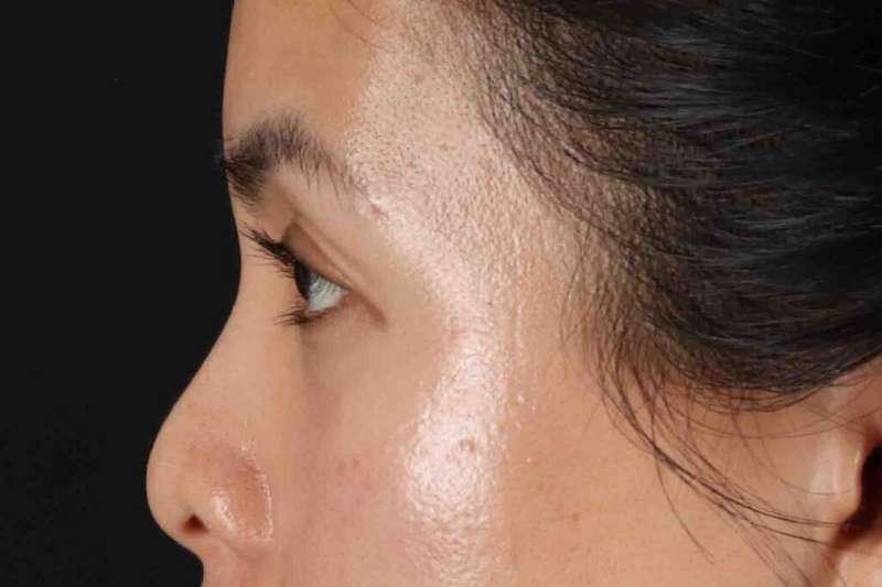 Blepharoplasty (Eyelid Surgery) Before & After Patient #4415