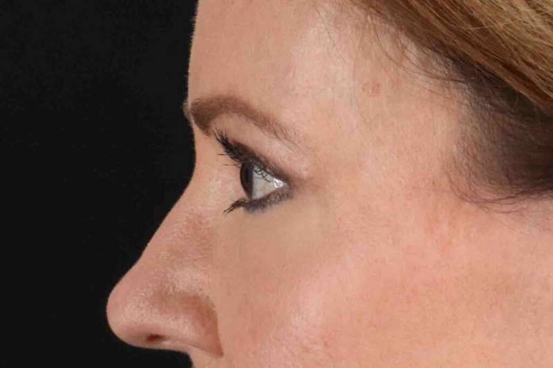 Blepharoplasty (Eyelid Surgery) Before & After Patient #4426