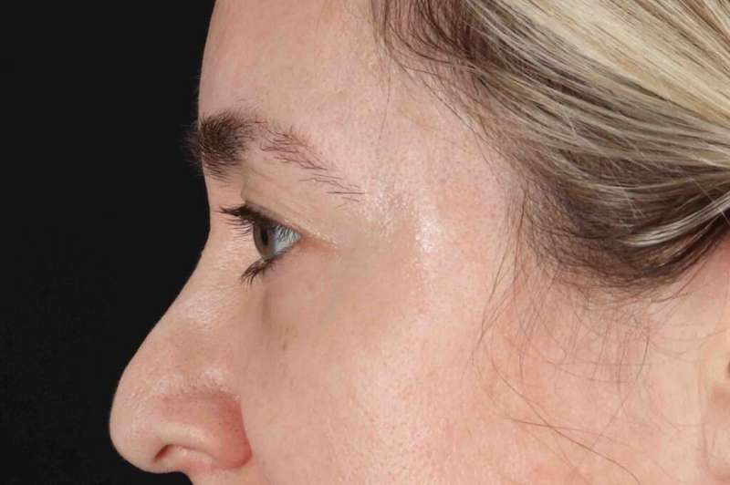 Blepharoplasty (Eyelid Surgery) Before & After Patient #4437