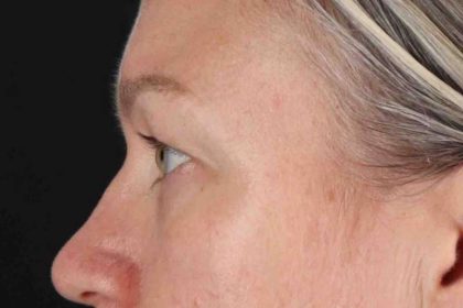 Blepharoplasty (Eyelid Surgery) Before & After Patient #4448