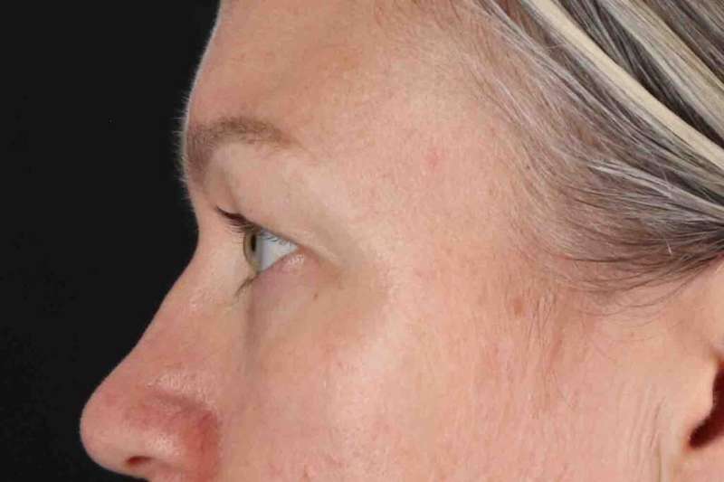Blepharoplasty (Eyelid Surgery) Before & After Patient #4448