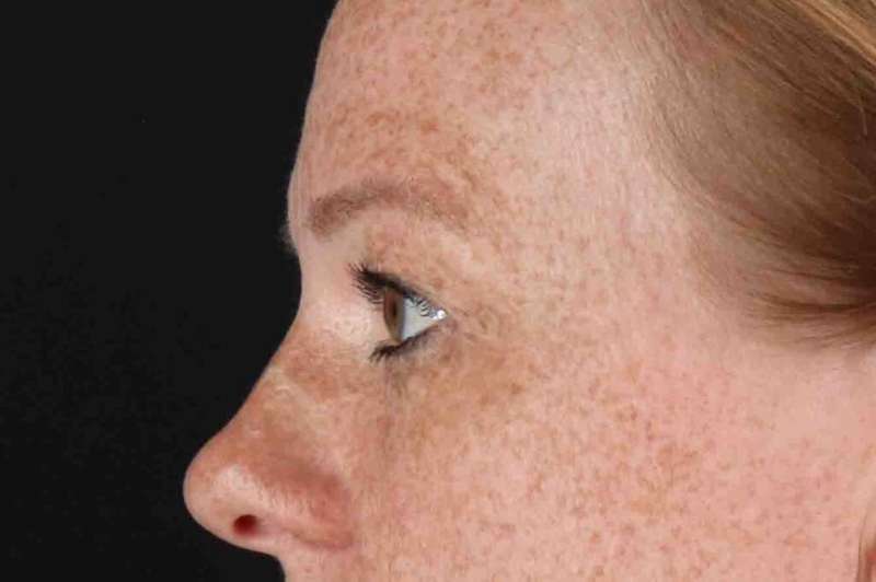 Blepharoplasty (Eyelid Surgery) Before & After Patient #4459