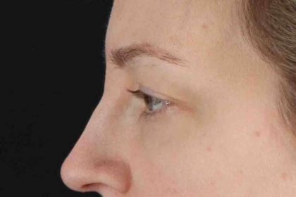 Blepharoplasty (Eyelid Surgery) Before & After Patient #4470