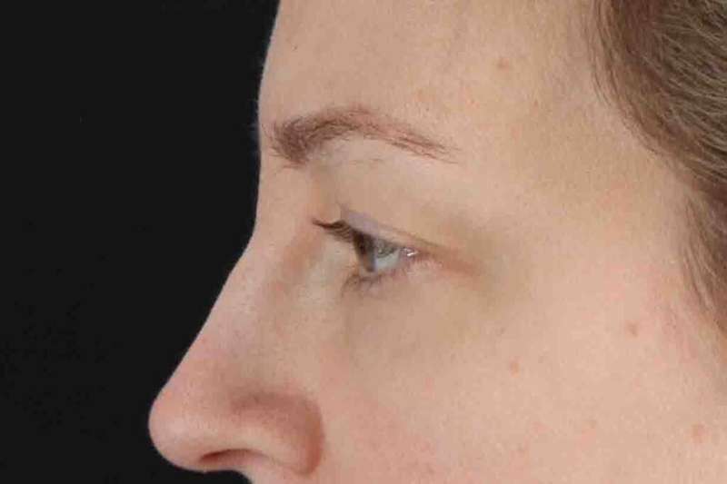 Blepharoplasty (Eyelid Surgery) Before & After Patient #4470