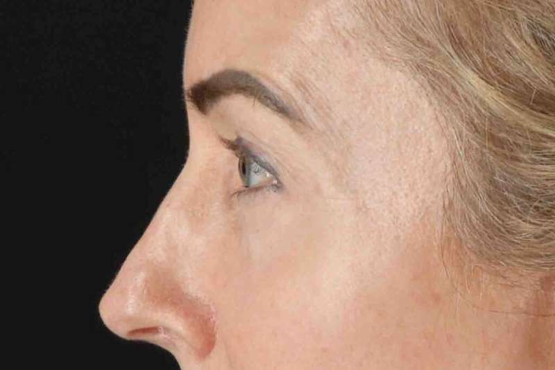 Blepharoplasty (Eyelid Surgery) Before & After Patient #4481