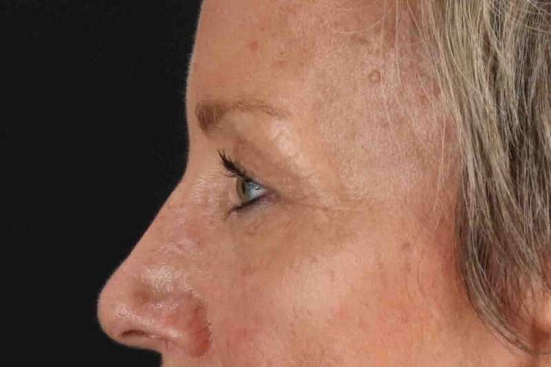 Blepharoplasty (Eyelid Surgery) Before & After Patient #4492