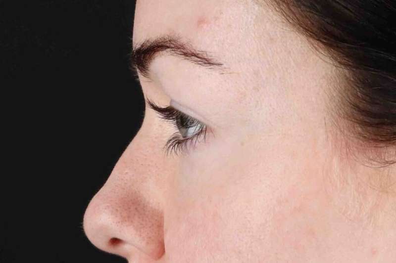 Blepharoplasty (Eyelid Surgery) Before & After Patient #4503