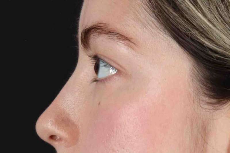 Blepharoplasty (Eyelid Surgery) Before & After Patient #4514