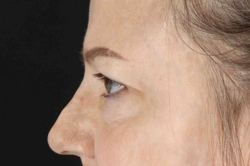 Blepharoplasty (Eyelid Surgery) Before & After Patient #4525