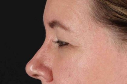 Blepharoplasty (Eyelid Surgery) Before & After Patient #4536