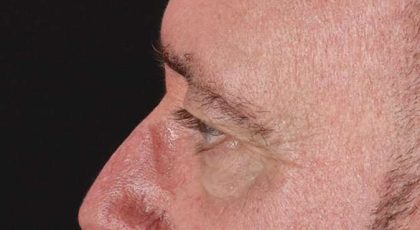 Blepharoplasty (Eyelid Surgery) Before & After Patient #4599