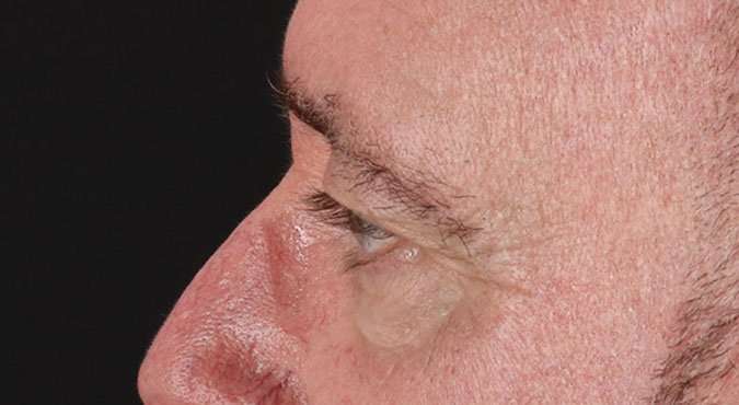 Blepharoplasty (Eyelid Surgery) Before & After Patient #4599