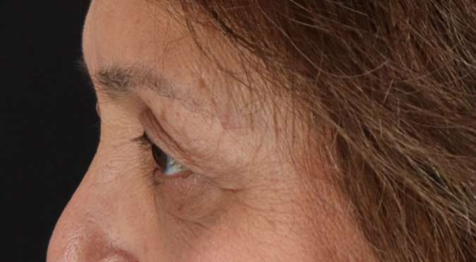 Blepharoplasty (Eyelid Surgery) Before & After Patient #4649
