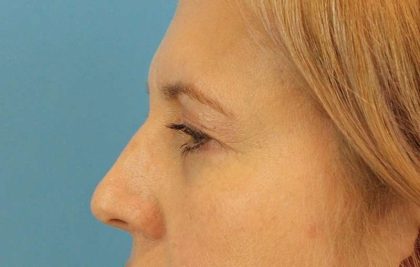 Brow Lift Before & After Patient #4672