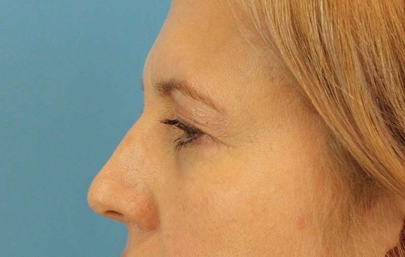 Brow Lift Before & After Patient #4672