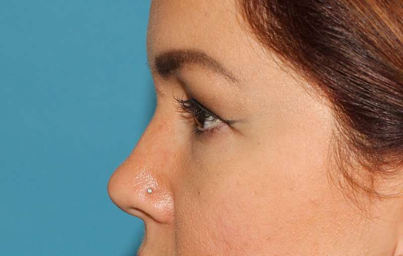 Brow Lift Before & After Patient #4690