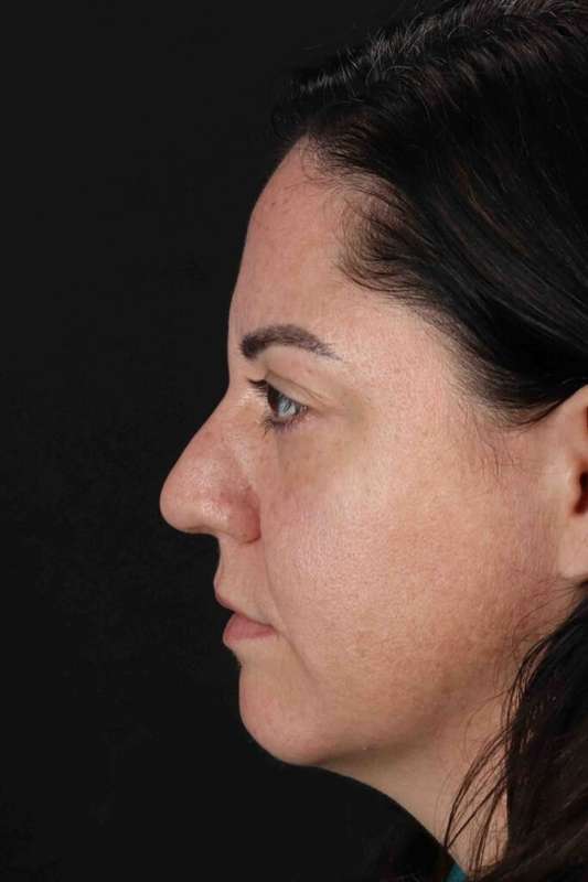 Brow Lift Before & After Patient #4733