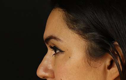 Brow Lift Before & After Patient #4744