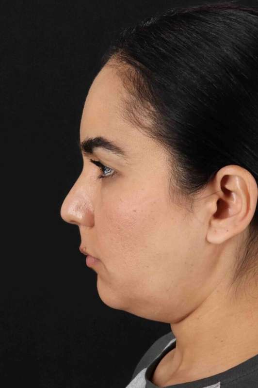 Brow Lift Before & After Patient #4755